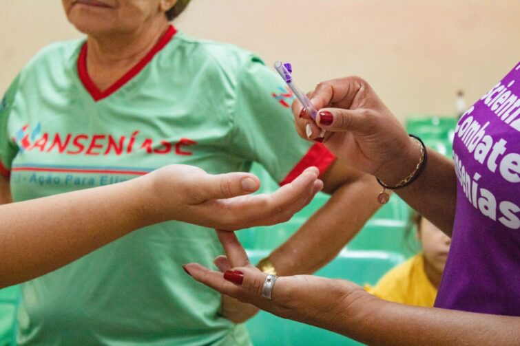 Presidente Figueiredo intensifica ações para garantir diagnóstico precoce da hanseníase e outras doenças da pele