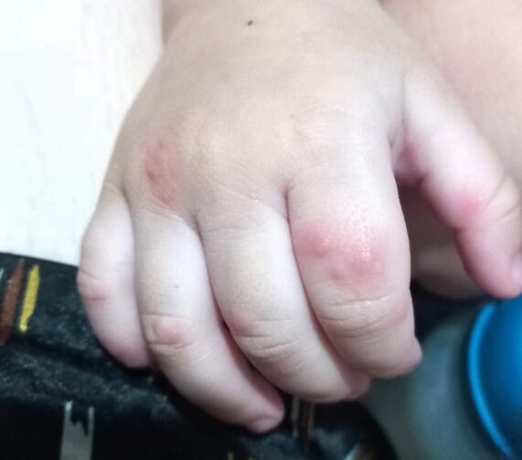 Mão-pé-boca: Saúde do Amazonas reforça cuidados contra a doença