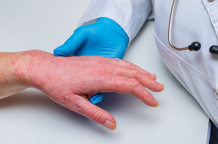 Janeiro Roxo alerta para diagnóstico precoce de hanseníase em Rondônia